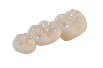 bruxzir_zirconia_bridge_glidewell_022